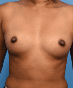 Breast Augmentation-Non Gummy