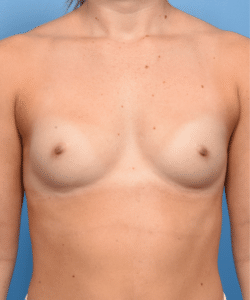 Breast Augmention- Non Gummy