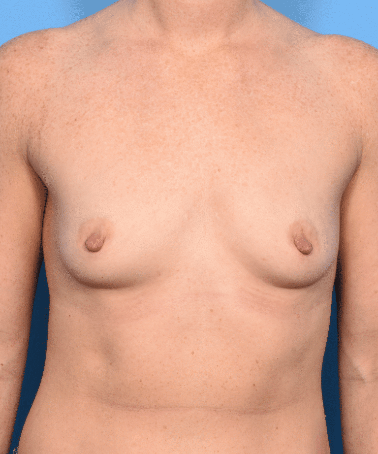Before Image: Breast Augmentation- Motiva - front