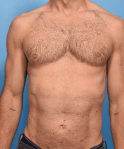 Liposuction and Renuvion