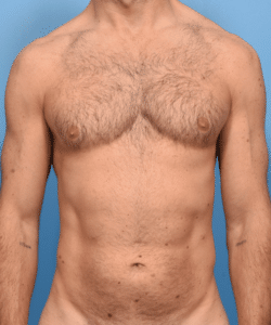 Liposuction and Renuvion