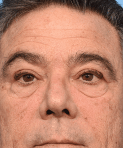 Four Eyelid Blepharoplasty