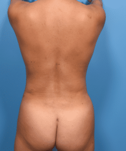 4D VASER Liposuction of the Abdomen, Flanks, Back with Fat Transfer to Buttocks and Hips in a Patient who already had a Tummy Tuck