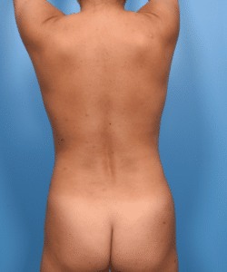 4D VASER Liposuction of the Abdomen, Flanks, Back with Fat Transfer to Buttocks and Hips in a Patient who already had a Tummy Tuck