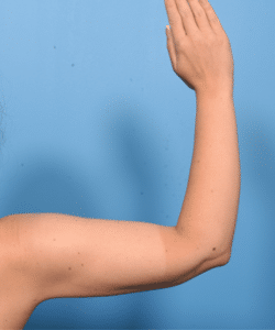 Liposuction and Renuvion of the Arms