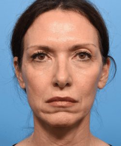 Facelift and Blepharoplasty with fat grafting
