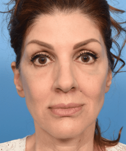 Deep plane rhytidectomy with platysmaplasty, lip lift, fat grafting to face