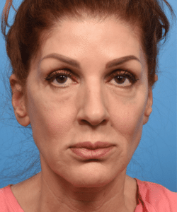 Deep plane rhytidectomy with platysmaplasty, lip lift, fat grafting to face