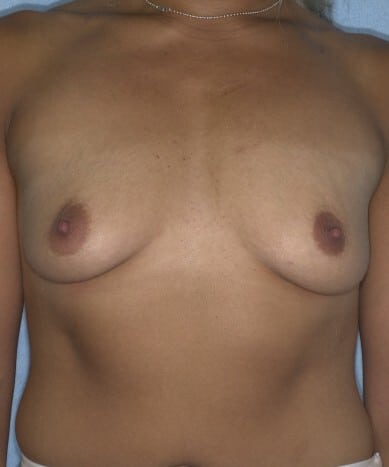 Before Image: Breast Augmentation – Saline Implants - front