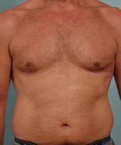 Gynecomastia