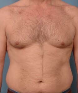 Gynecomastia