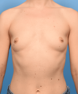 Breast Augmentation- Motiva