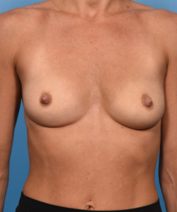 Breast Augmentation- Motiva