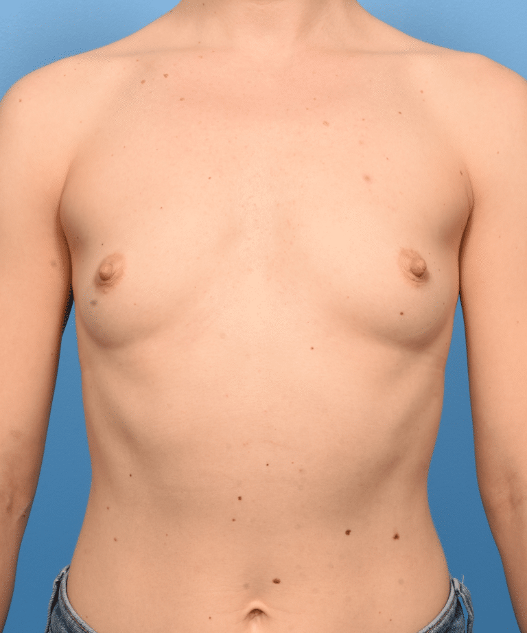 Before Image: Breast Augmentation- Motiva - front