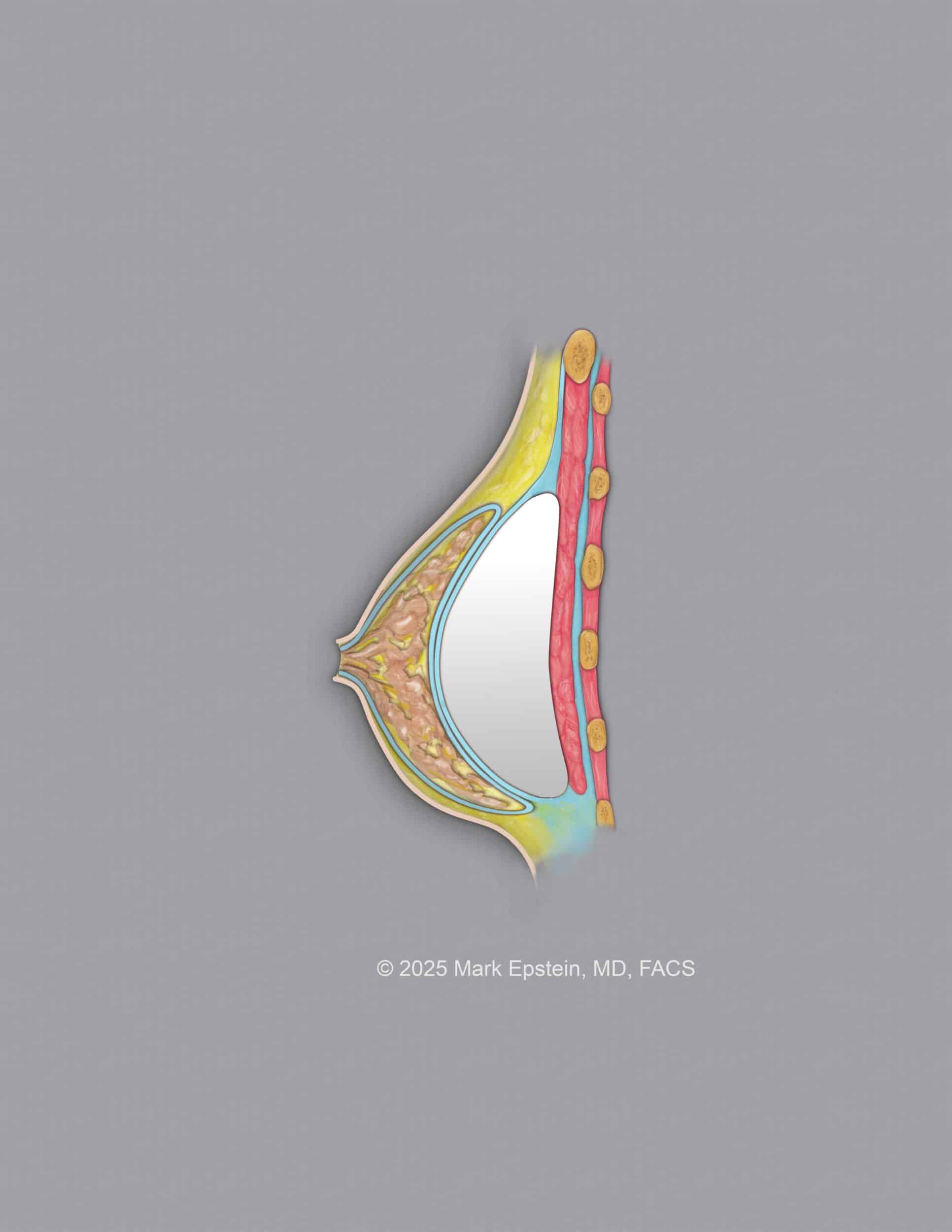 Implant below FINAL 3 600 dpi ©