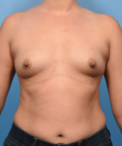 Breast Augmentation-Motiva