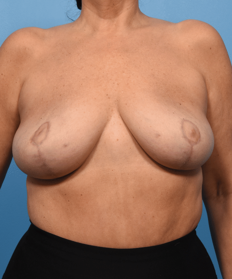 After Image: Bilateral Removal of Saline Implants, Mastopexy, Fat Grafting to Breasts - front