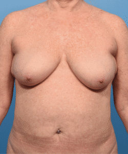 Breast Lift (Mastopexy ) with Fat Transfer