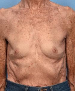Breast Augmentation- Motiva