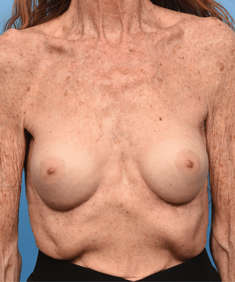 After Image: Breast Augmentation- Motiva - front