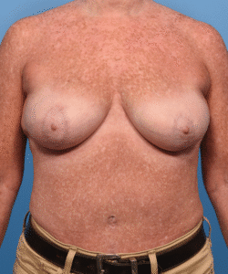 Breast Lift (Mastopexy ) with Fat Transfer