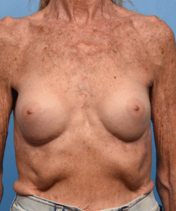 Breast Augmentation- Motiva
