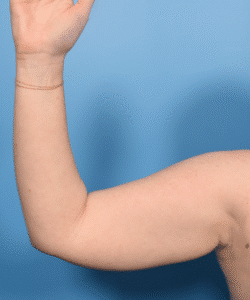 Liposuction and Renuvion- Arms