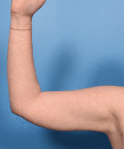 Liposuction and Renuvion- Arms