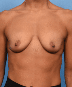 Breast Augmentation with Preservé™ Technique