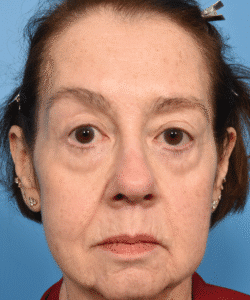 Deep plane rhytidectomy