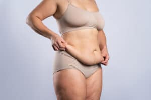 A cropped shot of a woman's stomach before a tummy tuck in Long Island