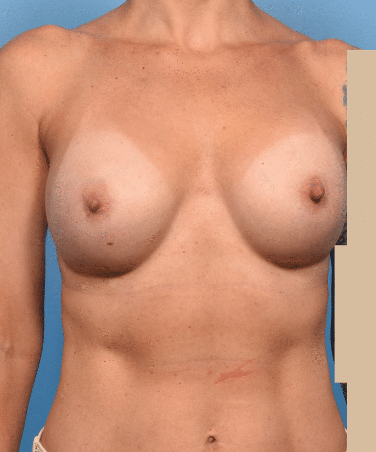 Before Image: Exchange of Mentor to Motiva Implant - front