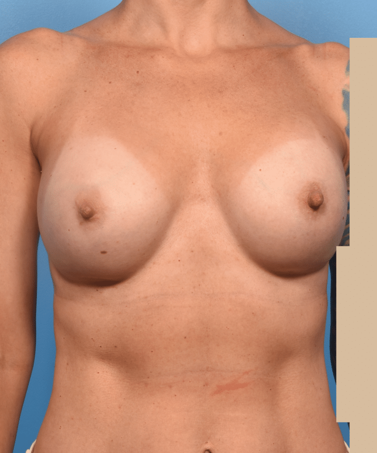Before Image: Exchange of Mentor to Motiva Implant - front