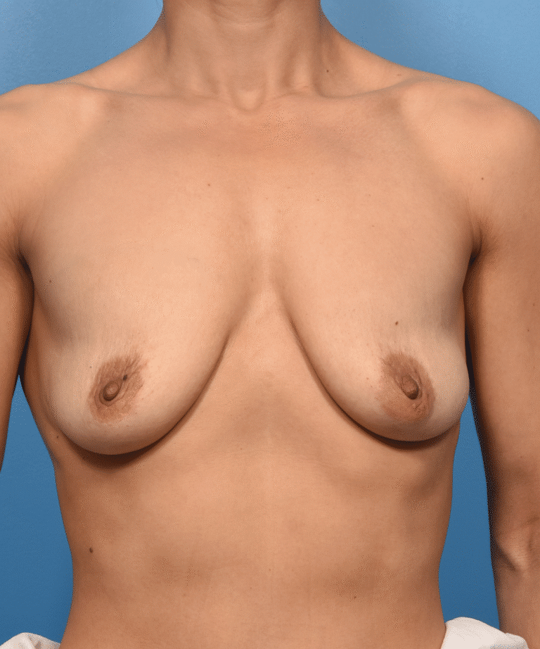 Before Image: Breast Augmentation w/ Motiva and Lift - front
