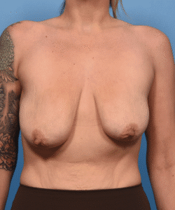 Breast Lift-Severely Asymmetric Breasts w/ Dermal Suspension