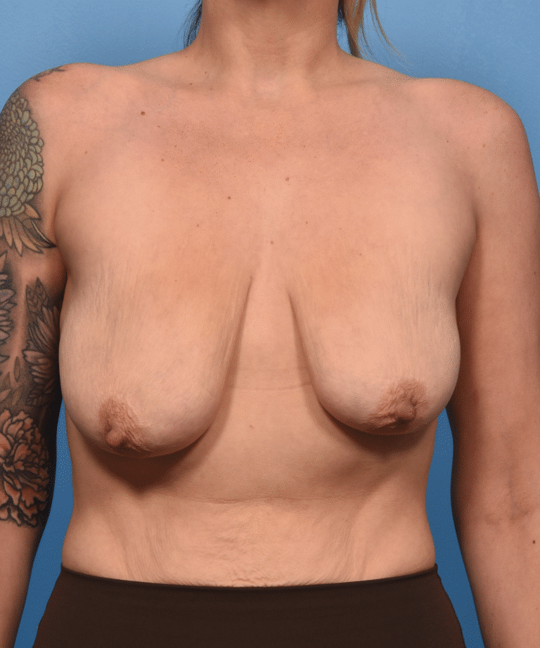 Before Image: Breast Lift-Severely Asymmetric Breasts w/ Dermal Suspension - front