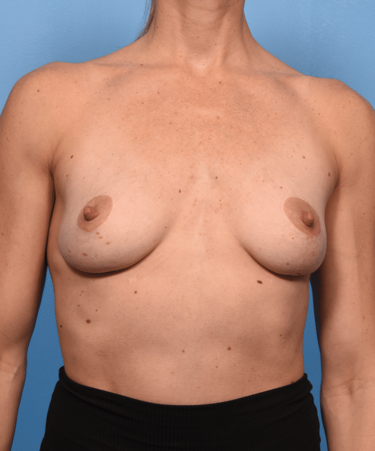 Before Image: Breast Augmentation with Preservé™ Technique - front