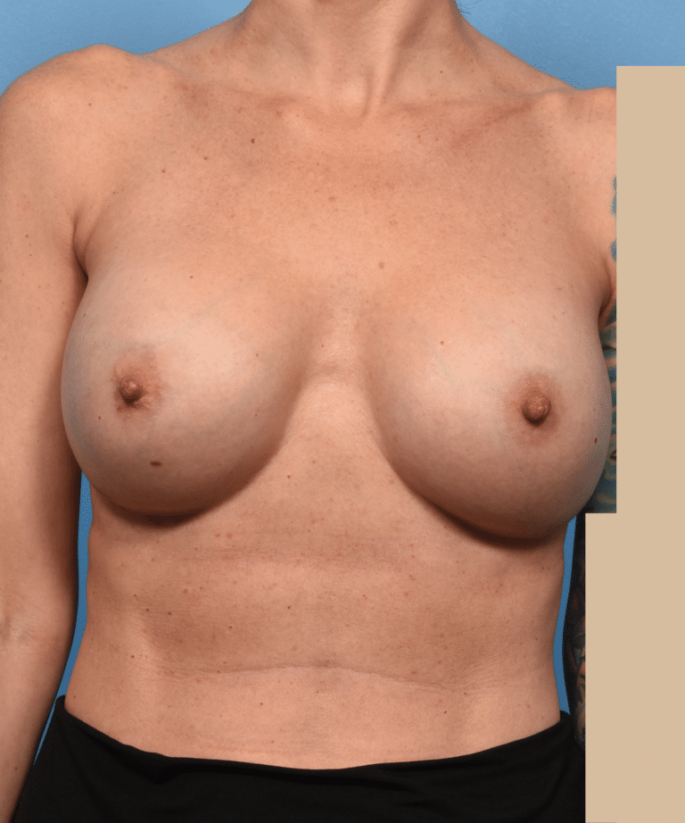 After Image: Exchange of Mentor to Motiva Implant - front