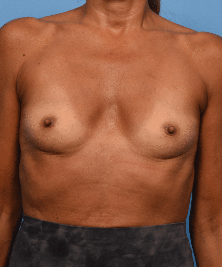 Before Image: Breast Augmentation with Preservé™ Technique - front