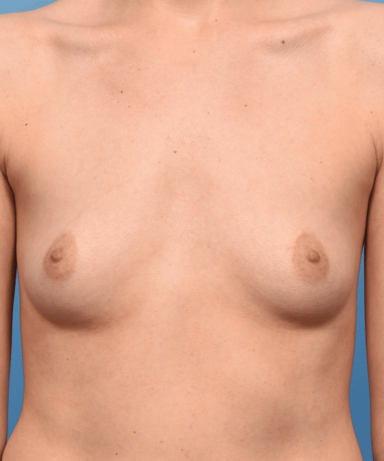 Before Image: Breast Augmentation with Preservé™ Technique - front