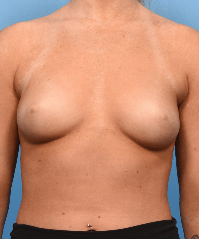 Before Image: Breast Augmentation- Motiva - front