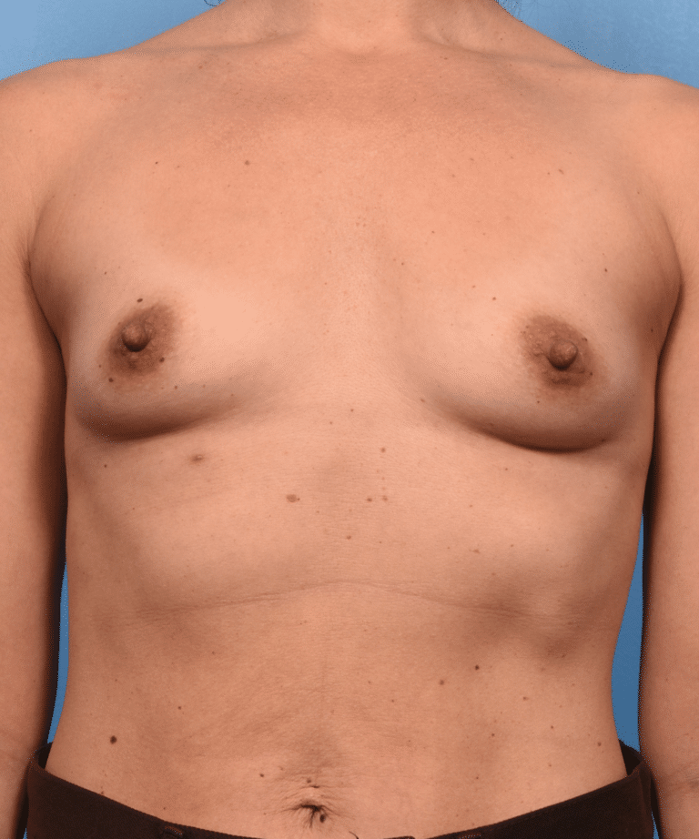 Before Image: Breast Augmentation with Preservé™ Technique - front