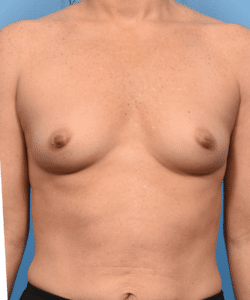 Breast Augmentation with Preservé™ Technique