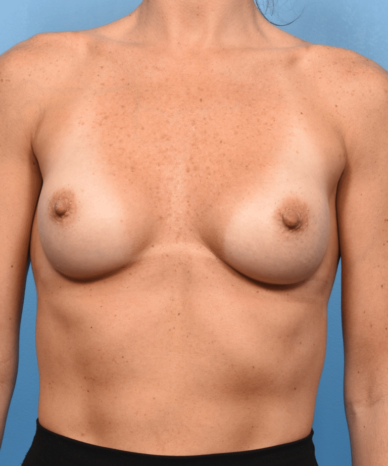After Image: Breast Augmentation with Preservé™ Technique - front