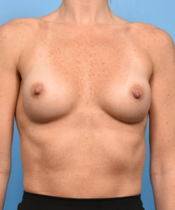 Breast Augmentation with Preservé™ Technique