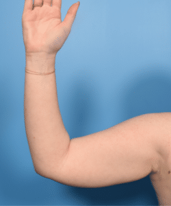 Liposuction & Renuvion-Arms