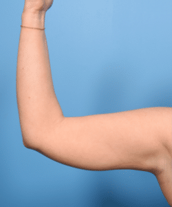 Liposuction & Renuvion-Arms