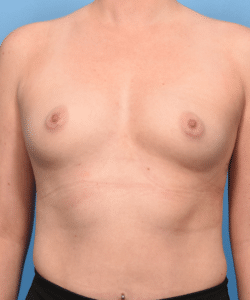 Breast Augmentation with Preservé™ Technique