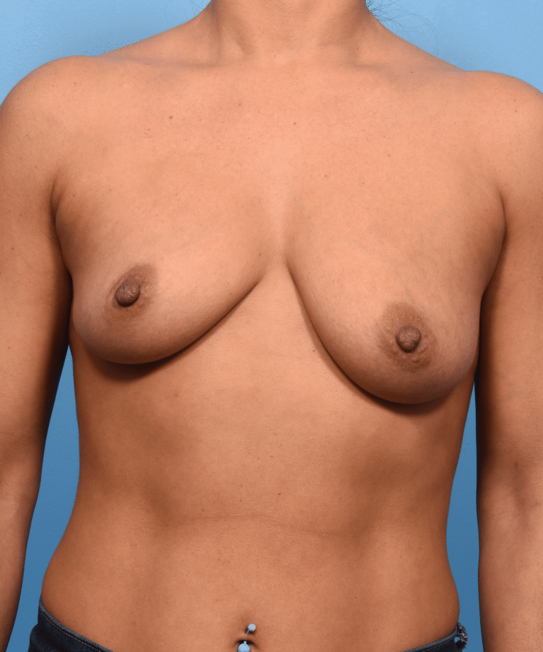 Before Image: Breast Augmentation with Preservé™ Technique - front