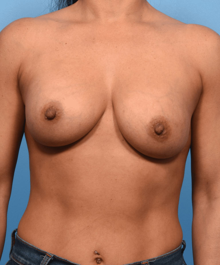 After Image: Breast Augmentation with Preservé™ Technique - front